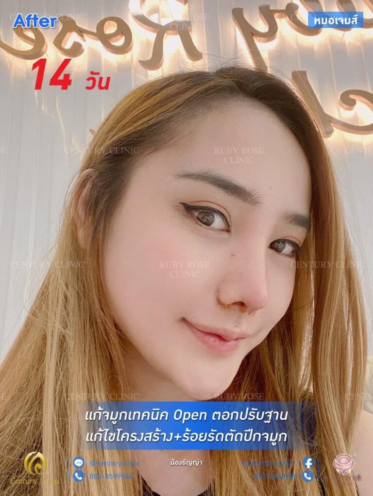 รีวิว แก้จมูก #91