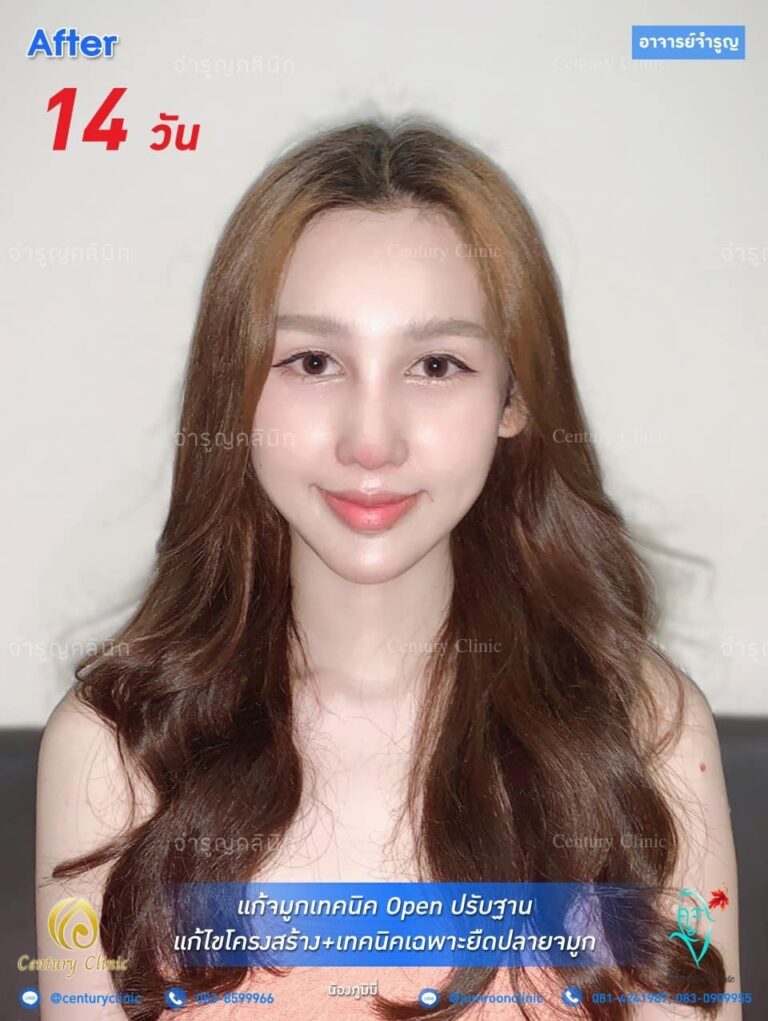 รีวิว แก้จมูก #92