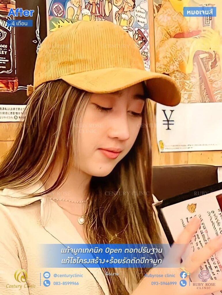 รีวิว แก้จมูก1 #128
