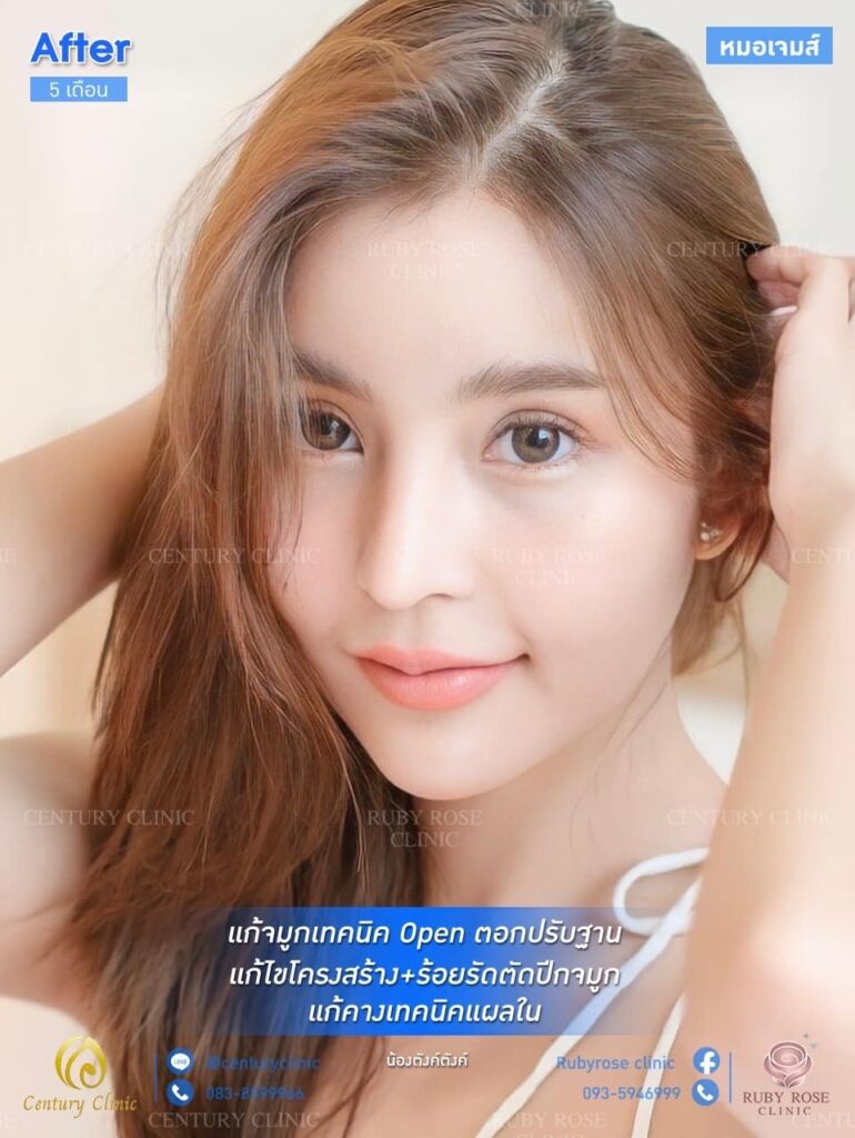 รีวิว แก้จมูก1 #72