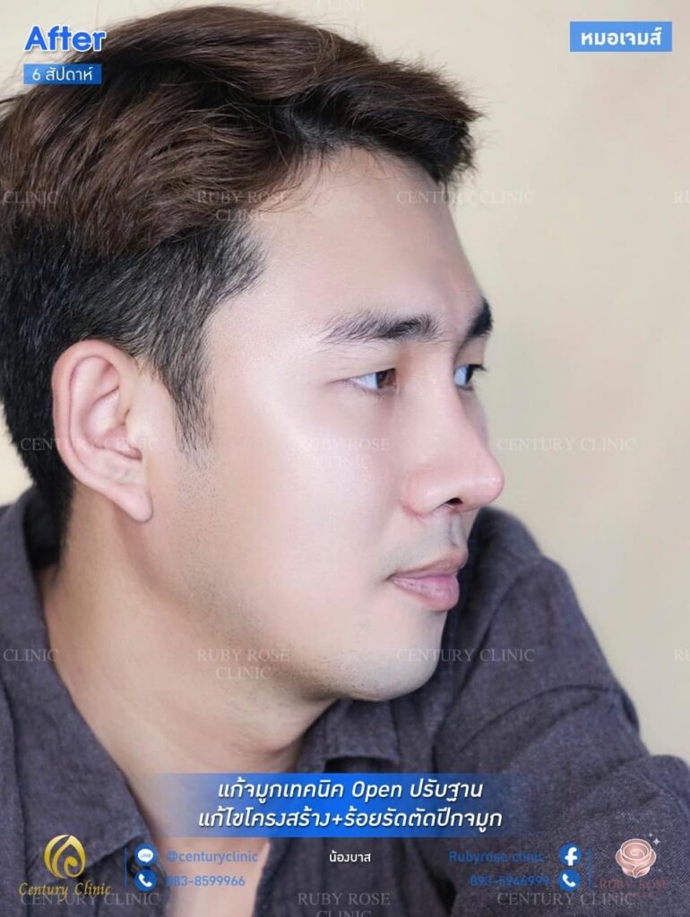 รีวิว แก้จมูก1 #76