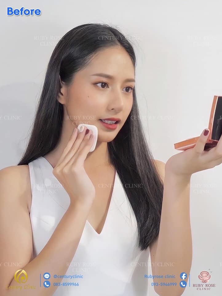 รีวิว แก้จมูก2 #103