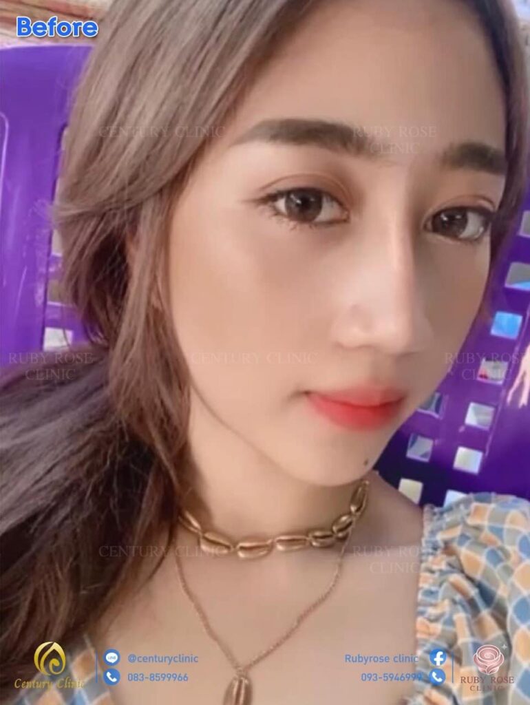 รีวิว แก้จมูก2 #128