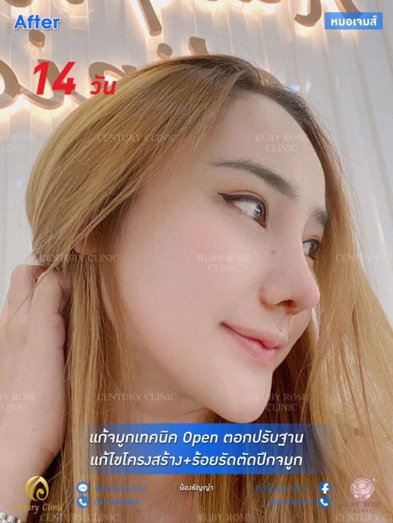 รีวิว แก้จมูก2 #91