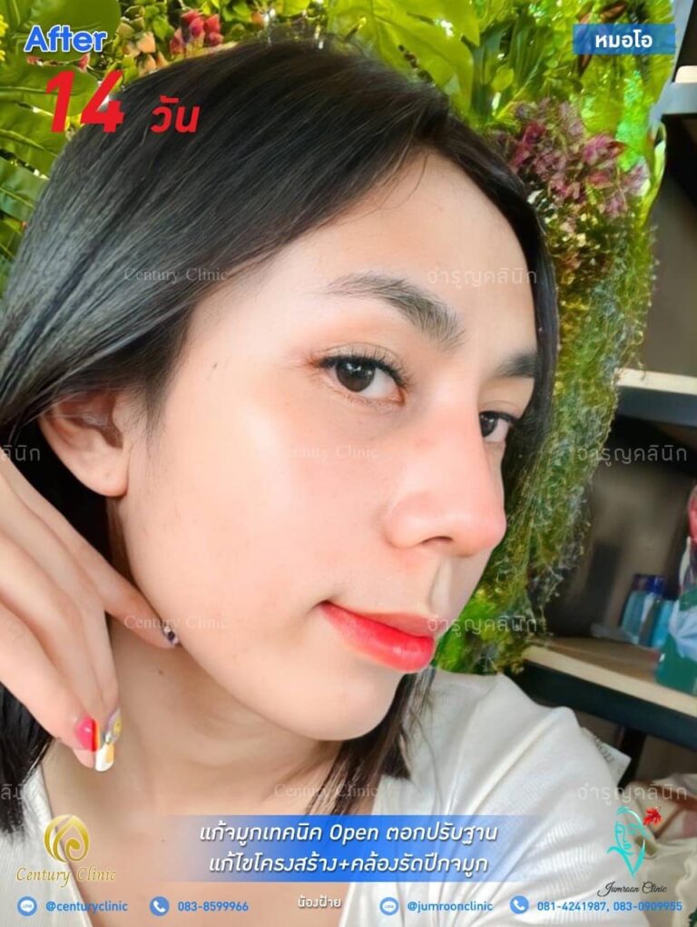 รีวิว แก้จมูก23-CenturyClinic