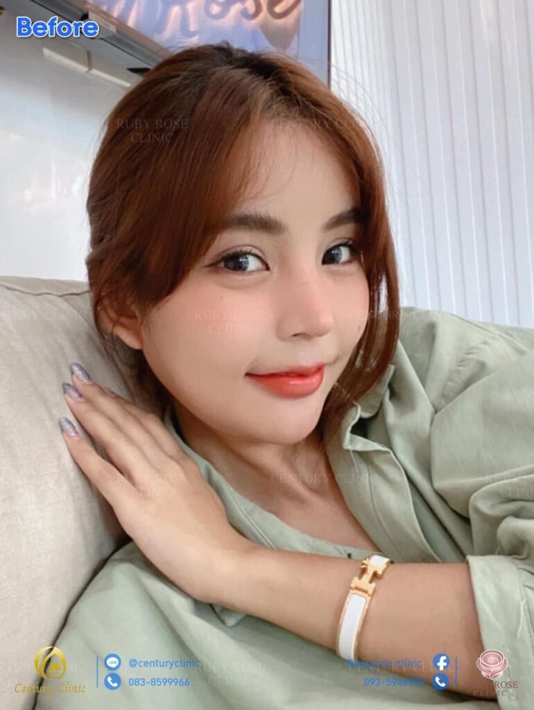 รีวิว แก้จมูก3 #72