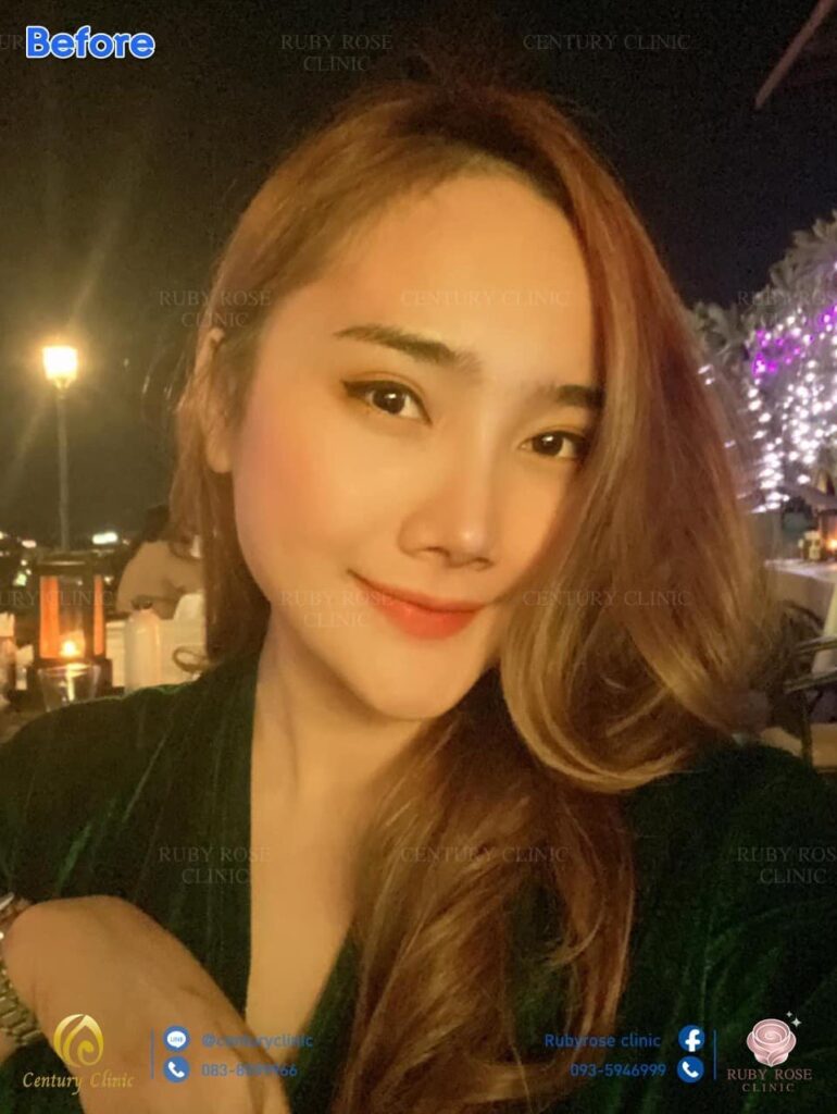 รีวิว แก้จมูก3 #91