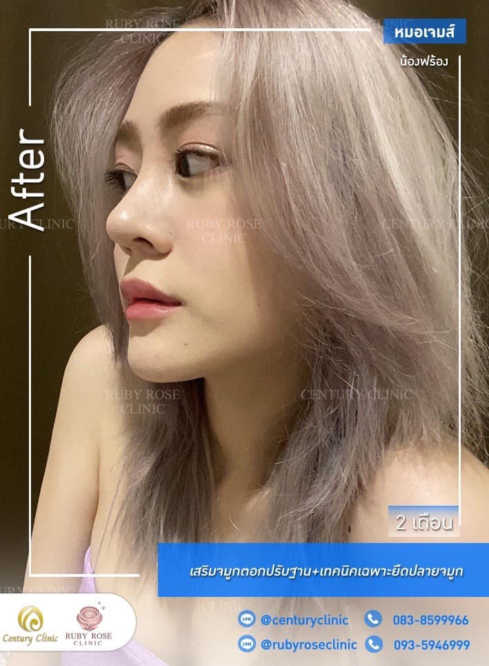 Century รีวิว เสริมจมูก 1#233