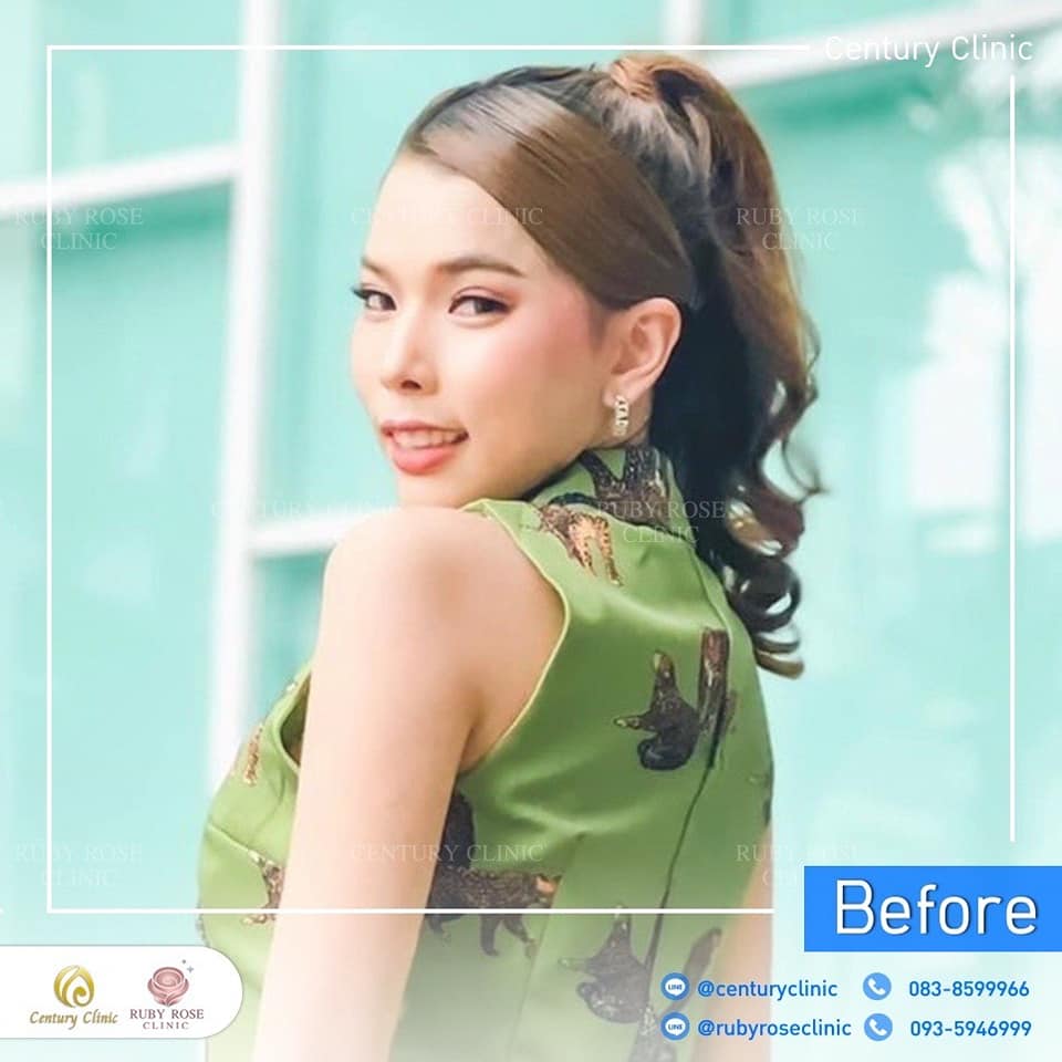 Century รีวิว เสริมจมูก 1#245