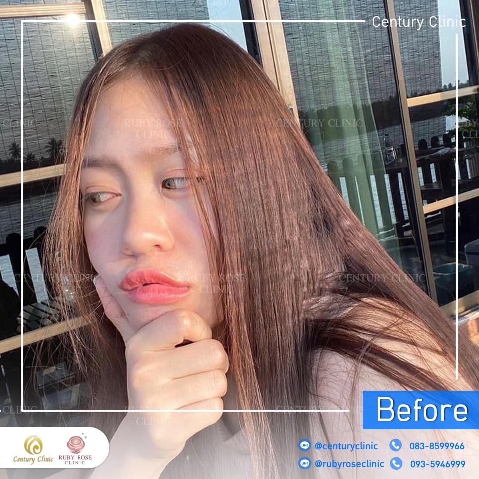 Century รีวิว เสริมจมูก 2#233