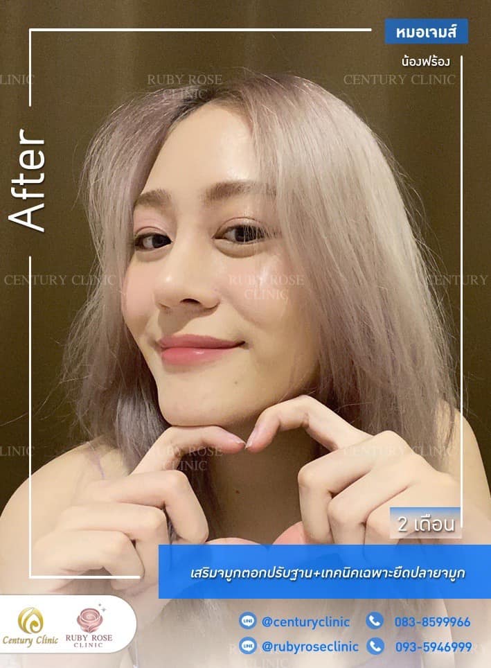 Century รีวิว เสริมจมูก #233