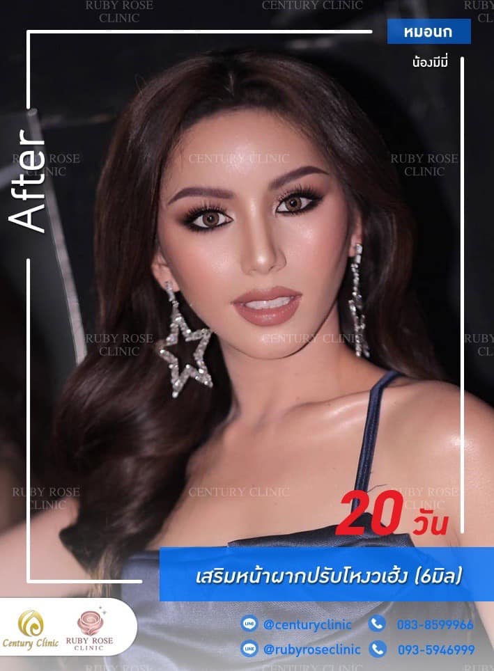 Century รีวิว เสริมหน้าผากปรับโหวงเฮ้ง 1#17