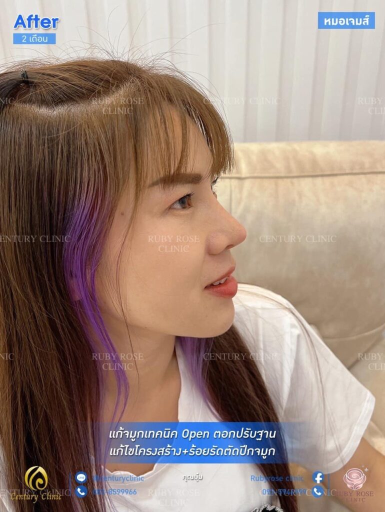 จมูกโด่งปลายพุ่งสวยกว่าทรงเดิมเยอะเลยค่ะ สำหรับคุณบุ๋ม ลูกสาวหมอเจมส์ ที่เดิมเสริมมาสันจมูกต่ำแล้วปีกจมูกกว้าง ทำให้ หน้าดูแบนไม่มีมิติ ตอนนี้แก้จมูกไปได้ครบ 2 เดือนแล้ว ต้องบอกเลยว่า ทรงใหม่สวยเข้ากับใบหน้า มิติใบหน้าก็ดีขึ้นด้วยค่ะ