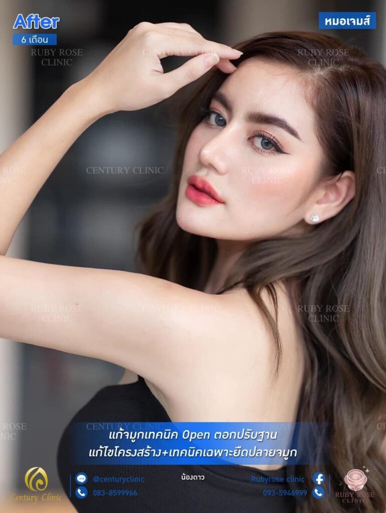Century รีวิว แก้จมูก 1#175