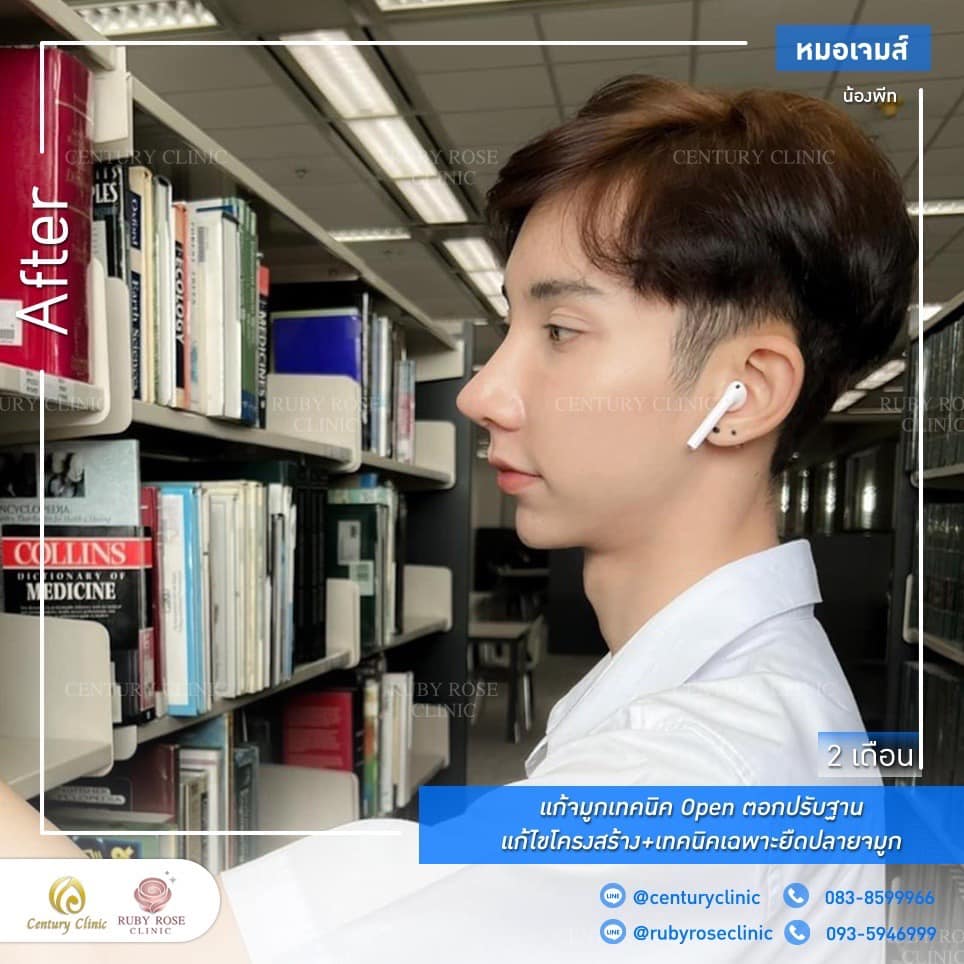 รีวิว แก้จมูก #192 , Century Clinic Thailand Century รีวิว แก้จมูก 1#192