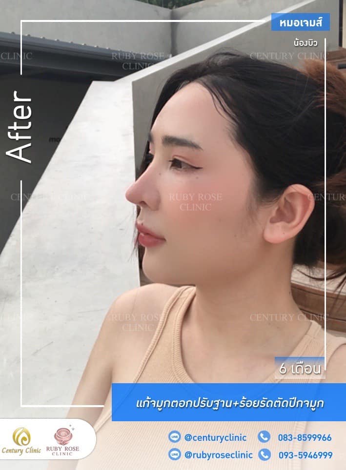 รีวิว แก้จมูก #224 , Century Clinic Thailand Century รีวิว แก้จมูก 1#224