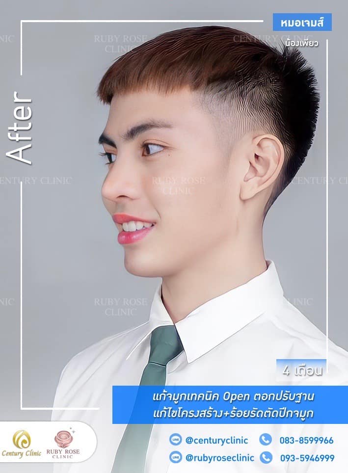 Century รีวิว แก้จมูก 1#227
