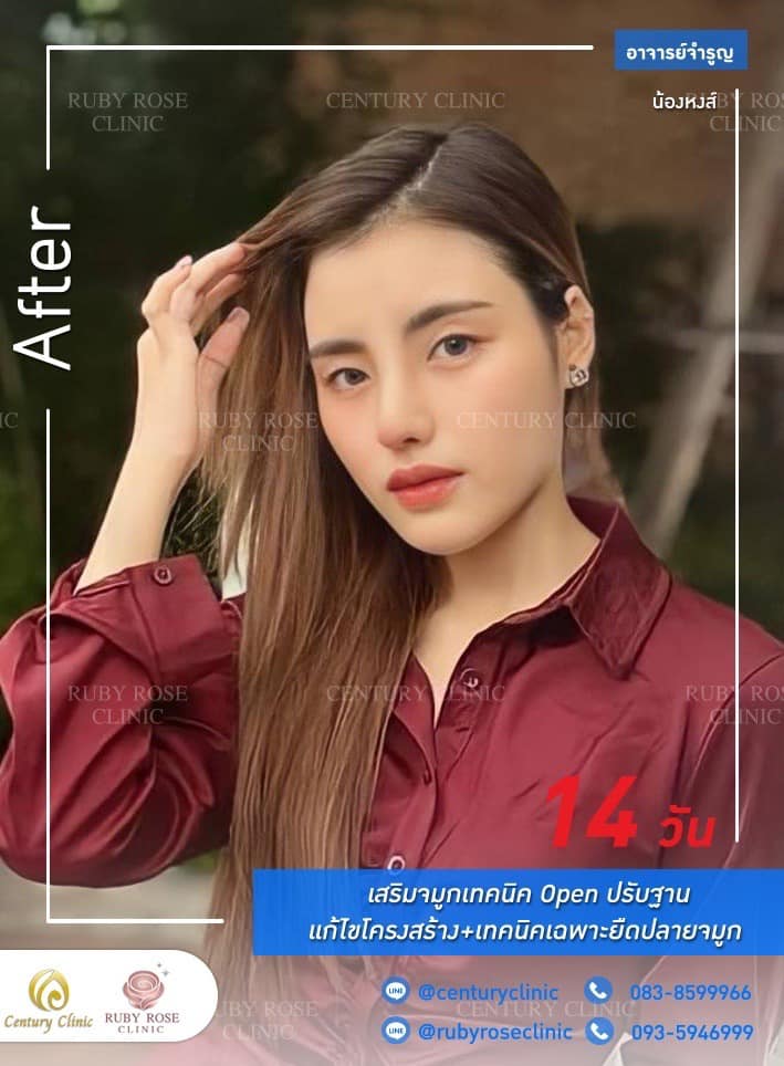 รีวิว เสริมจมูก #231 , Century Clinic Thailand Century รีวิว แก้จมูก 1#231