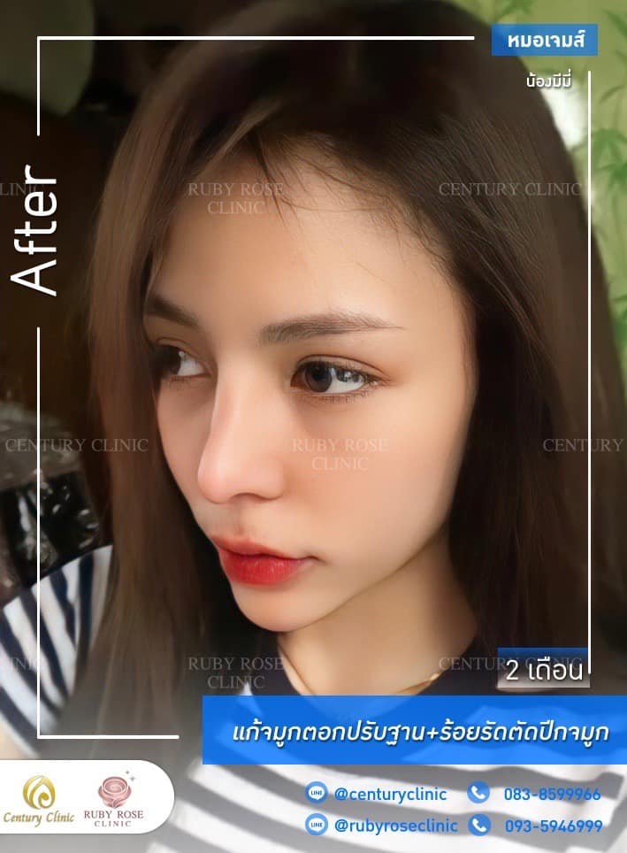 รีวิว แก้จมูก #250 , Century Clinic Thailand Century รีวิว แก้จมูก 1#250