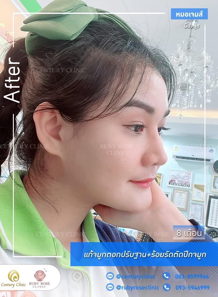รีวิว แก้จมูก #259 , Century Clinic Thailand Century รีวิว แก้จมูก 1#259