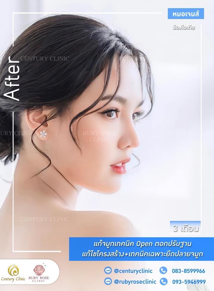 Century รีวิว แก้จมูก 1#262