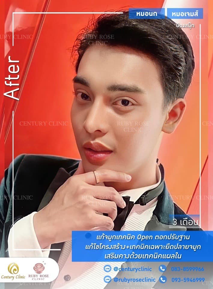 Century รีวิว แก้จมูก 1#274