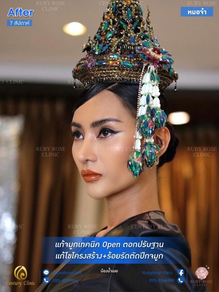 Century รีวิว แก้จมูก #167