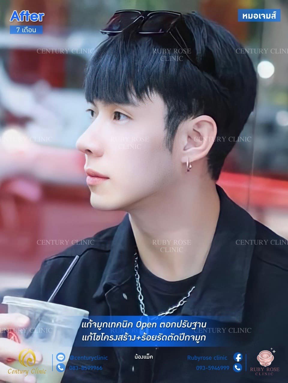 Century รีวิว แก้จมูก #173