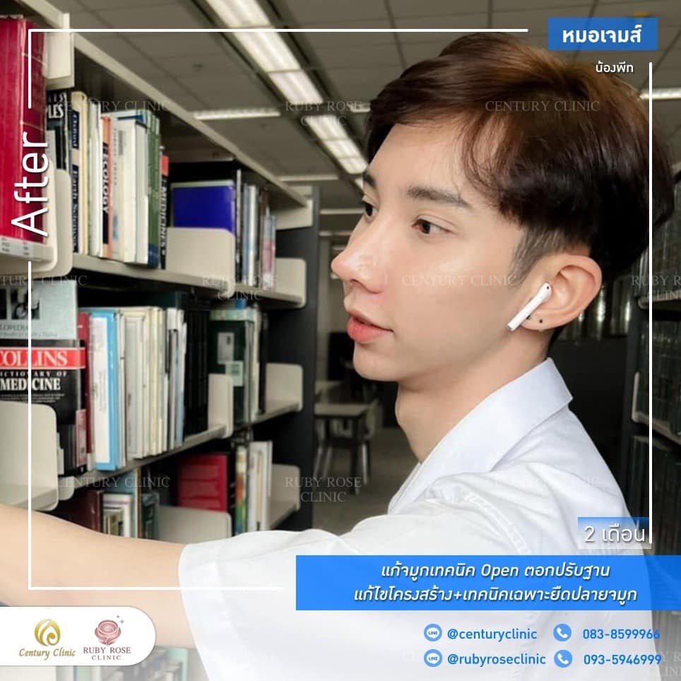 รีวิว แก้จมูก #192 , Century Clinic Thailand Century รีวิว แก้จมูก #192
