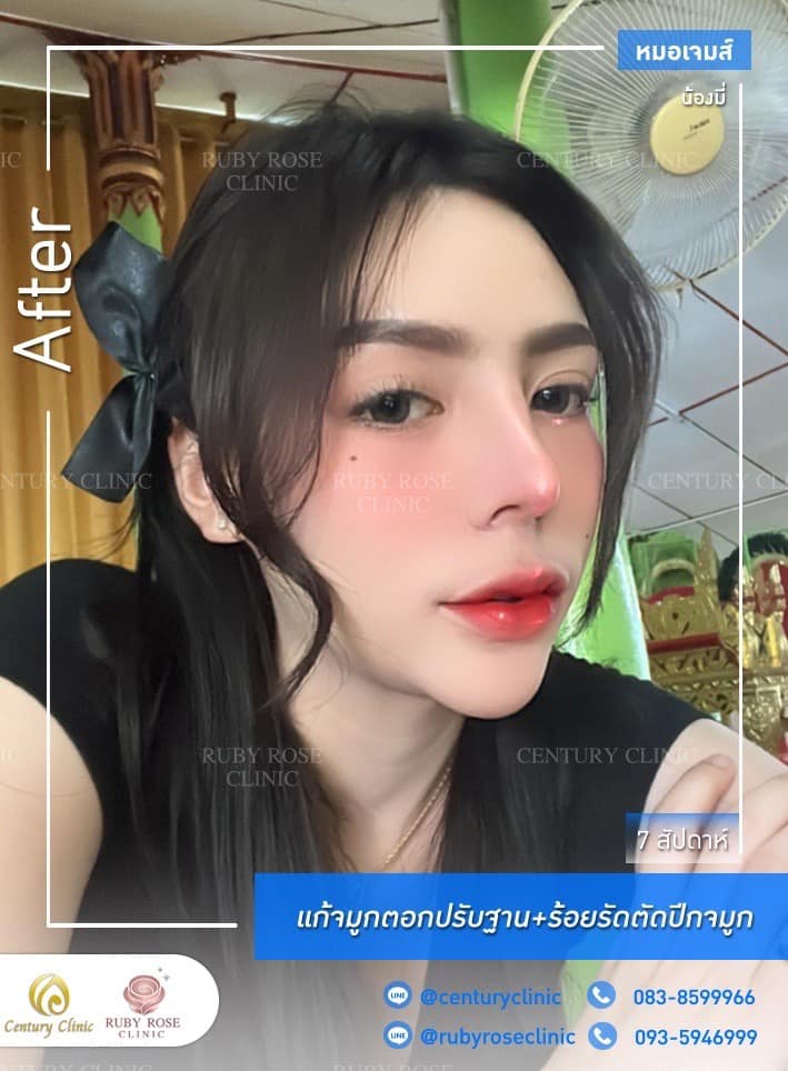 รีวิว แก้จมูก #199 , Century Clinic Thailand Century รีวิว แก้จมูก #199