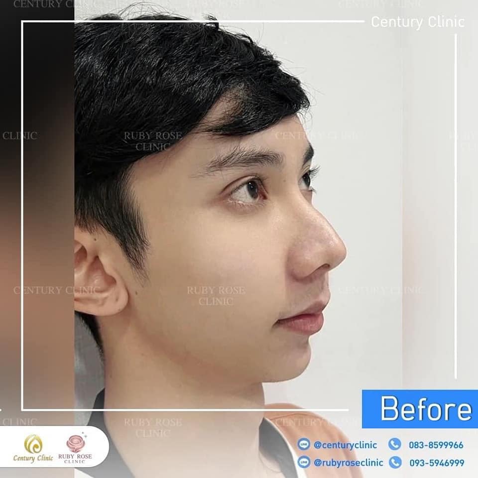 รีวิว แก้จมูก #192 , Century Clinic Thailand Century รีวิว แก้จมูก 2#192