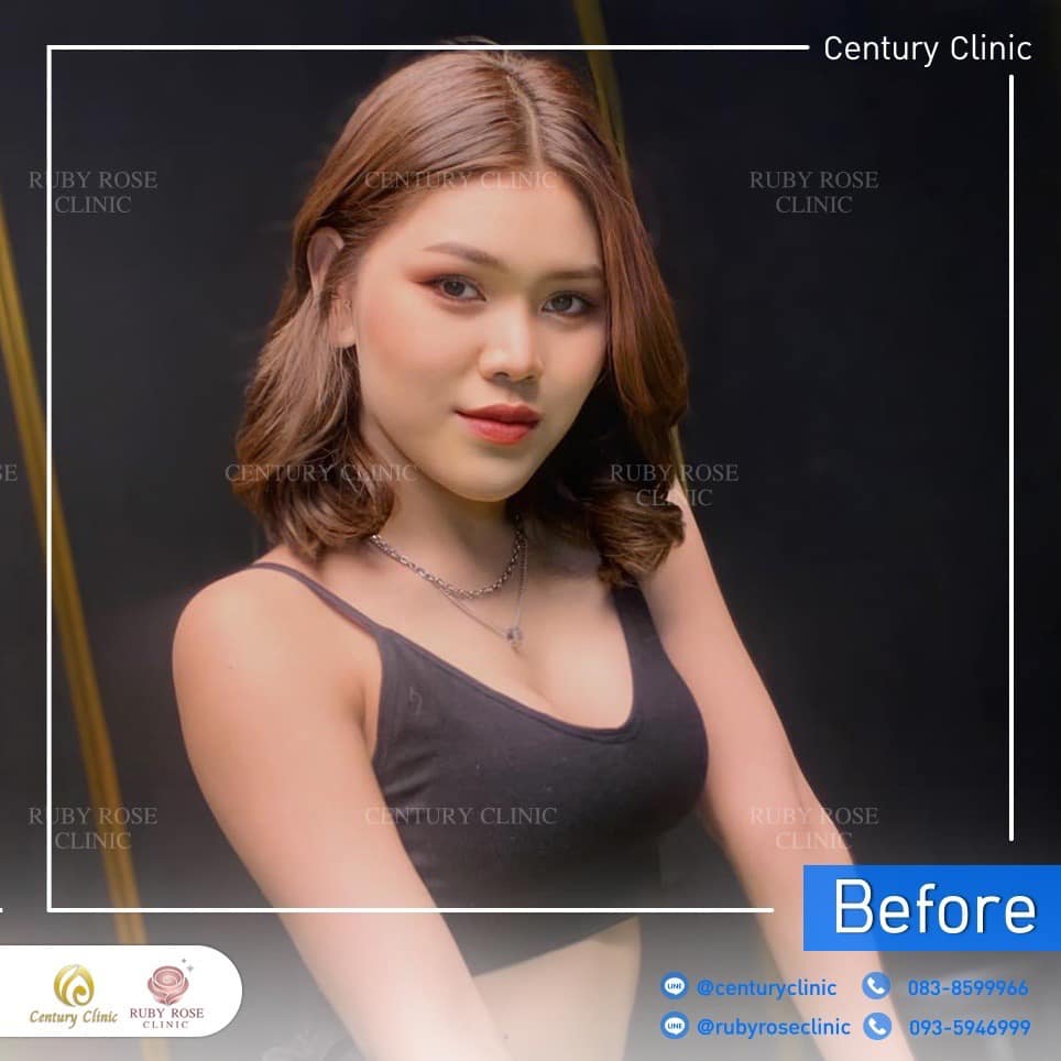รีวิว แก้จมูก #195 , Century Clinic Thailand Century รีวิว แก้จมูก 2#195