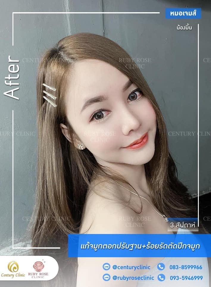 Century รีวิว แก้จมูก #221