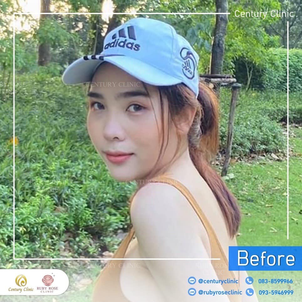 รีวิว แก้จมูก #224 , Century Clinic Thailand Century รีวิว แก้จมูก 2#224