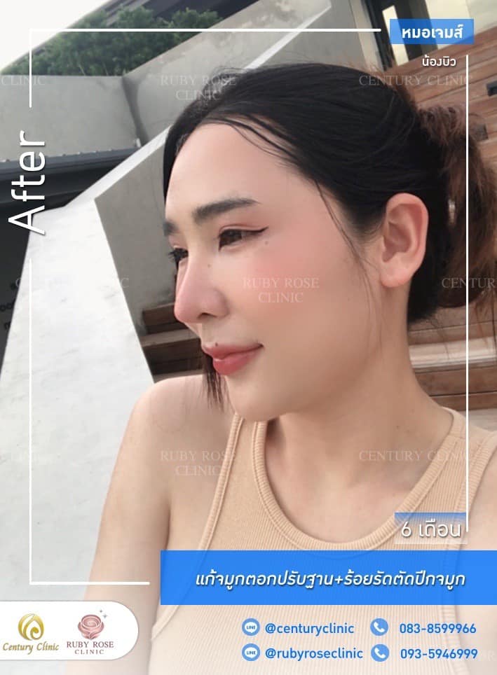 รีวิว แก้จมูก #224 , Century Clinic Thailand Century รีวิว แก้จมูก #224