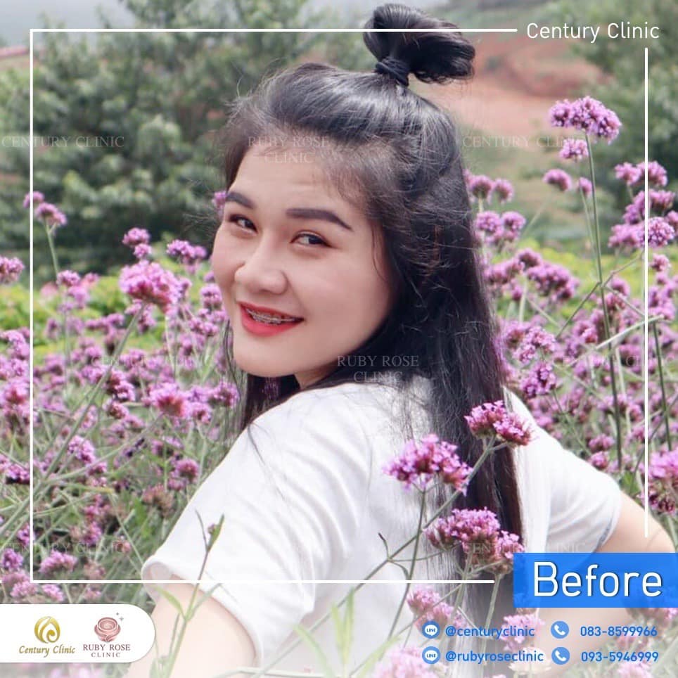 รีวิว แก้จมูก #259 , Century Clinic Thailand Century รีวิว แก้จมูก 2#259