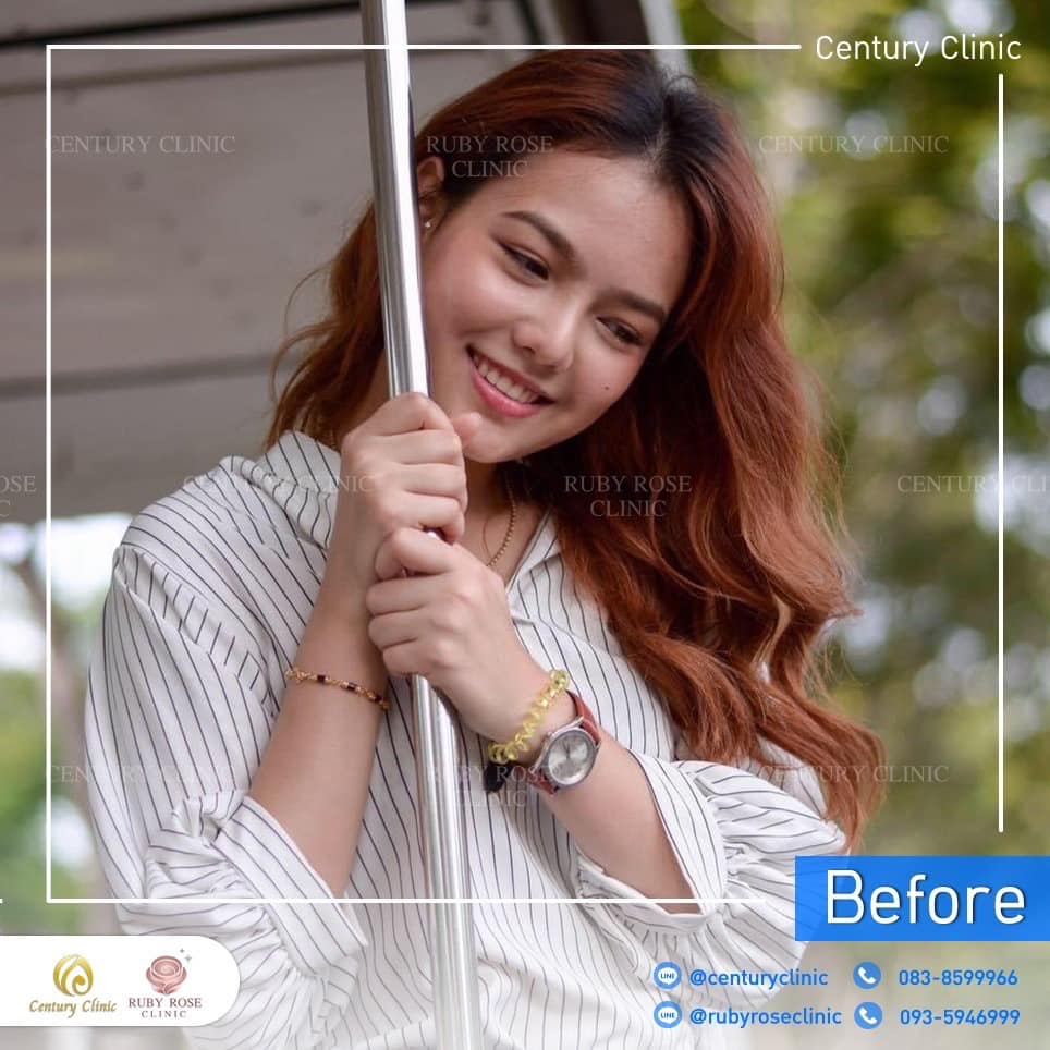 Century รีวิว แก้จมูก 2#262