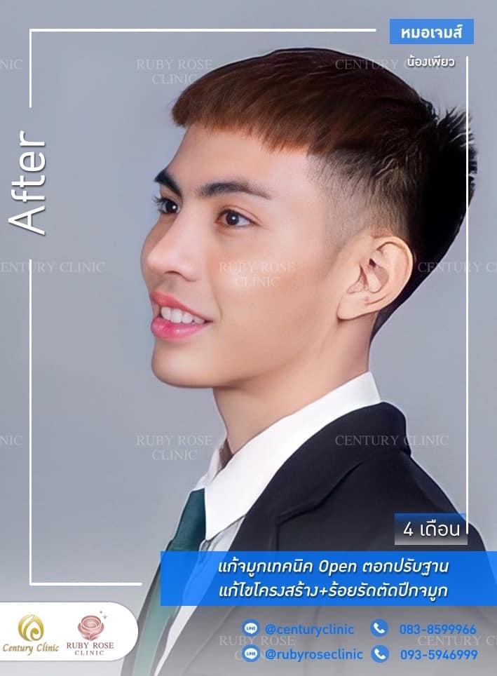Century รีวิว แก้จมูก #227