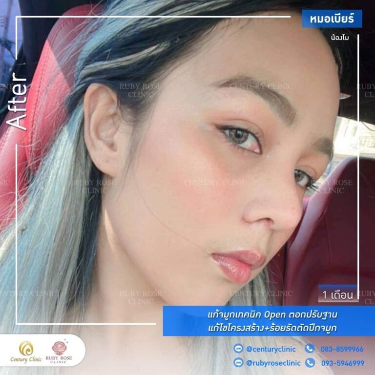Century รีวิว แก้จมูก #228