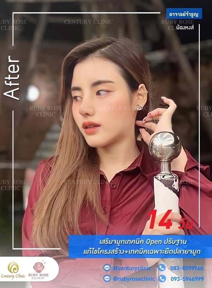 รีวิว เสริมจมูก #231 , Century Clinic Thailand Century รีวิว แก้จมูก #231