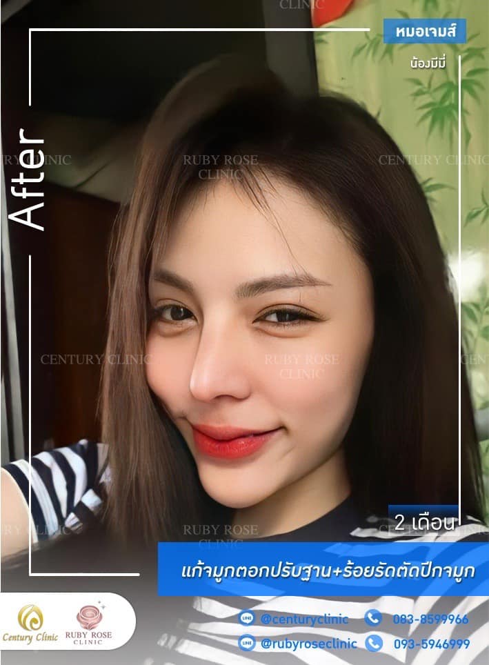 รีวิว แก้จมูก #250 , Century Clinic Thailand Century รีวิว แก้จมูก #250