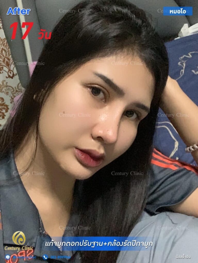Century รีวิว แก้จมูก #254