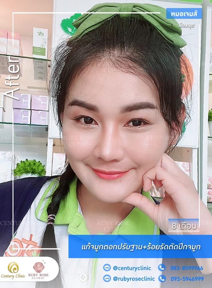 รีวิว แก้จมูก #259 , Century Clinic Thailand Century รีวิว แก้จมูก #259