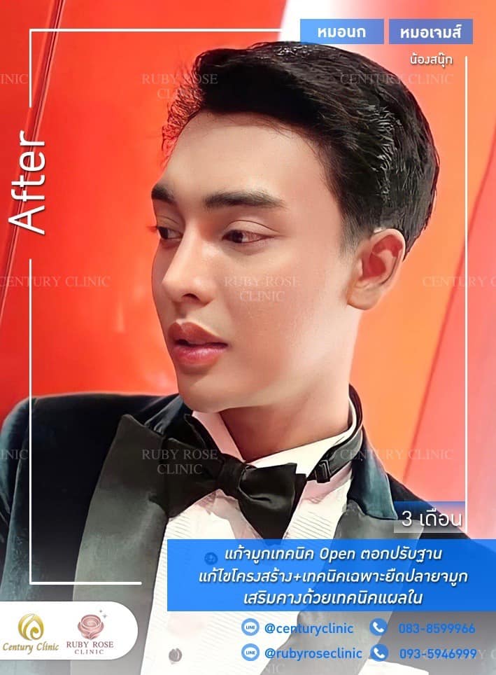 Century รีวิว แก้จมูก #274