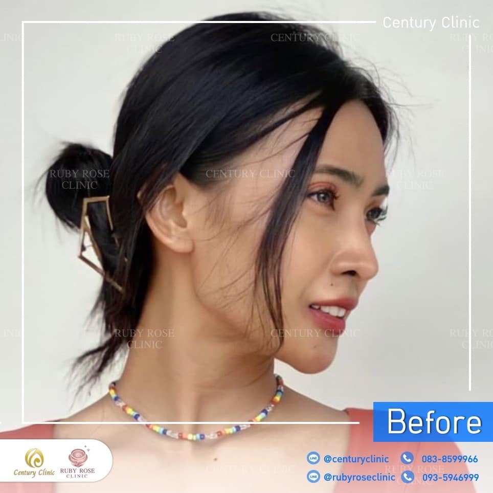 รีวิว แก้จมูก #194 , Century Clinic Thailand Century รีวิว แก้จมูก 3#194