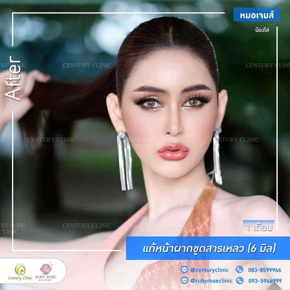 รีวิว แก้หน้าผากขูดสารเหลว1#16