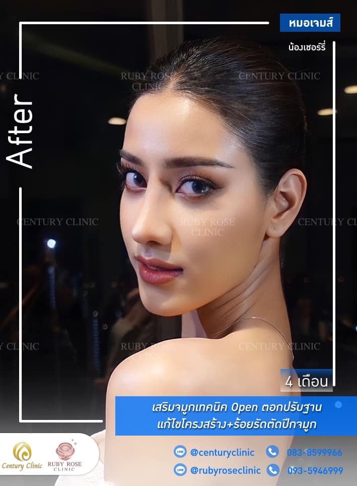 รีวิว เสริมจมูก #337 , Century Clinic Thailand Century-รีวิว-เสริมจมูก 1#337