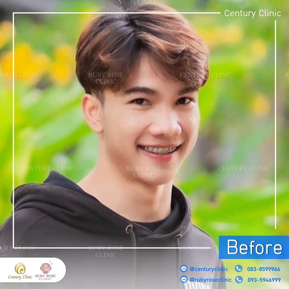 รีวิว เสริมจมูก #357 , Century Clinic Thailand Century-รีวิว-เสริมจมูก 1#357