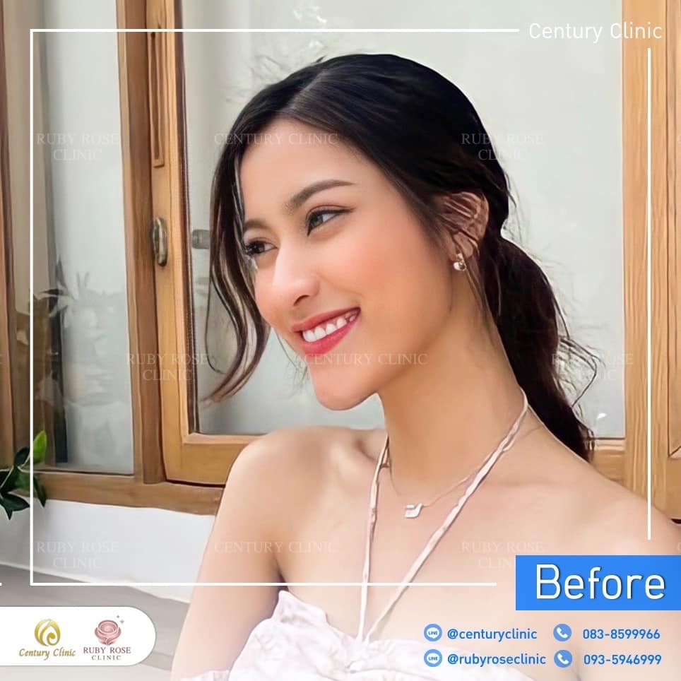 รีวิว เสริมจมูก #337 , Century Clinic Thailand Century-รีวิว-เสริมจมูก 2#337
