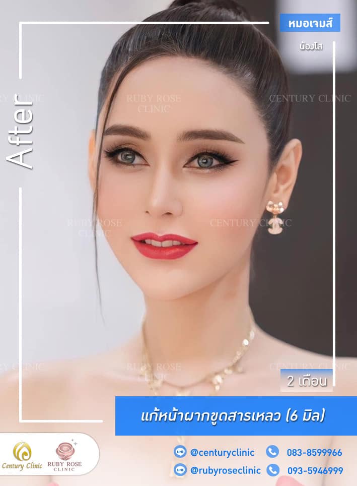 Century รีวิว เสริมหน้าผากปรับโหวงเฮ้ง 1#18